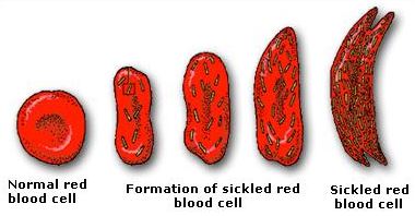 Sickle Cells